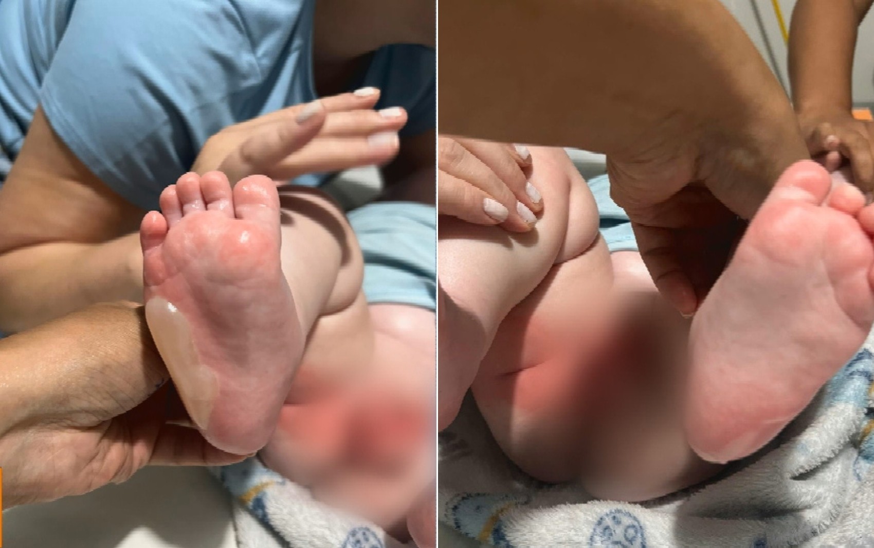 Bebê de 7 meses tem corpo queimado durante banho em berçário, em Rio Verde